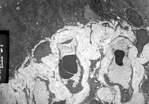 F,45y. | jejunum … amyloidosis F,45y. | jejunum … amyloidosis